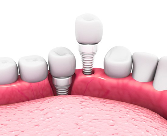 Digital illustration of ceramic dental implants