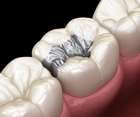 a computer illustration of a metal filling in a tooth