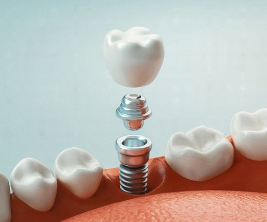 dental implant with crown in the lower jaw