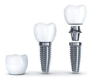dental implant crown, abutment, and post