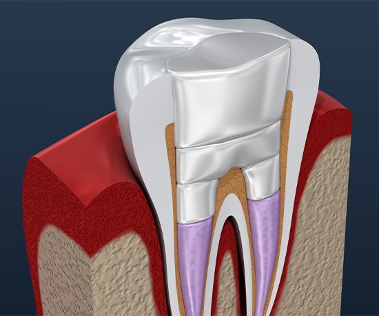 Animation of tooth after root canal