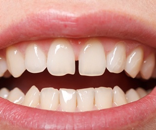 Closeup of gap between front teeth in Murphy before braces