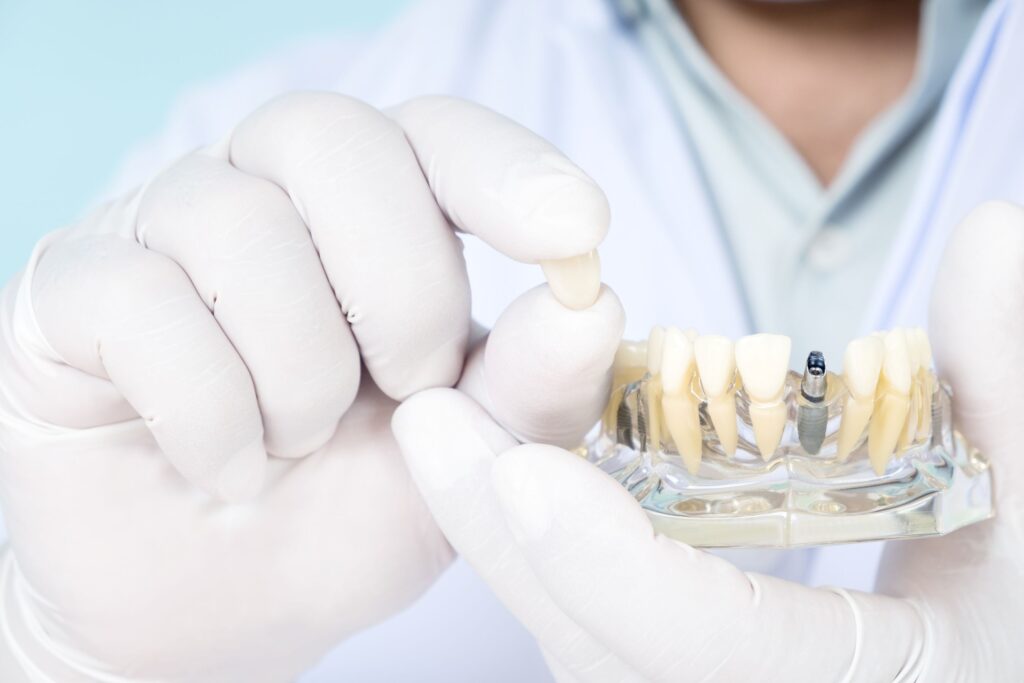 Closeup of white-gloved hand holding sample dental implants